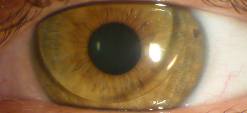 Formstabile Kontaktlinse